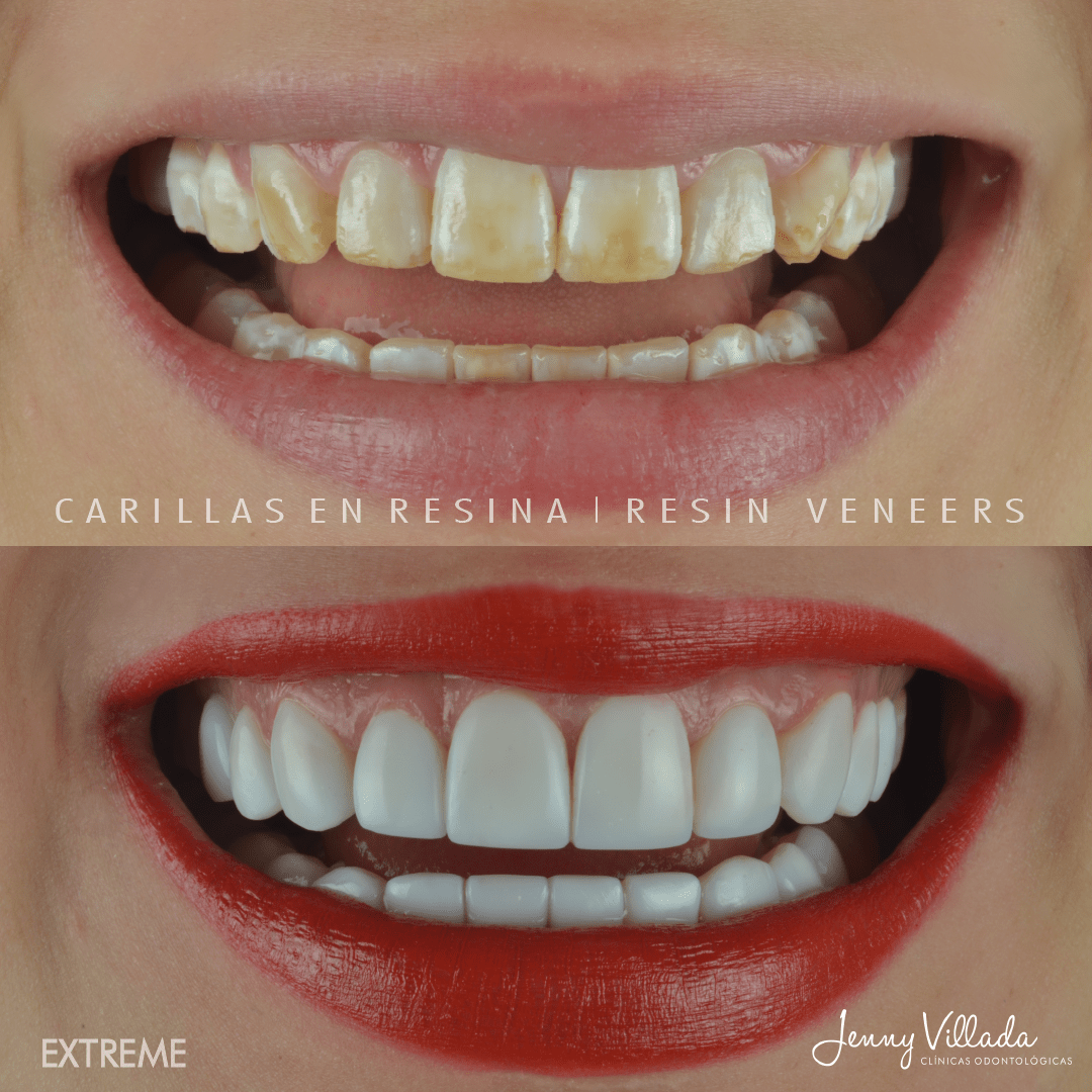 Resin veneers Dra Jenny Villada